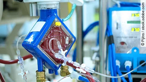 ECMO - erstmals im Einsatz zur emporäre Kreislauftrennung der Leber