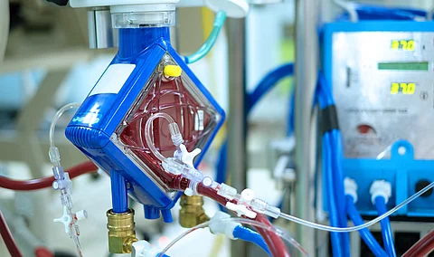 ECMO - erstmals im Einsatz zur emporäre Kreislauftrennung der Leber