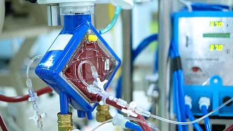 ECMO - erstmals im Einsatz zur emporäre Kreislauftrennung der Leber