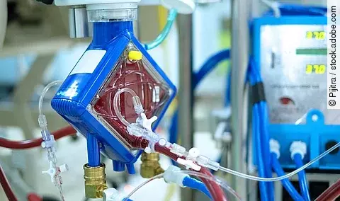 ECMO - erstmals im Einsatz zur emporäre Kreislauftrennung der Leber
