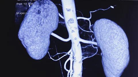 CT angiogram (CTA) shown the abdominal aorta, kidney and common iliac artery. Calcified plaques in lower part of aorta. Atherosclerotic change. CT angiography for determine vascular disease trauma. CT angiogram (CTA) shown the abdominal aorta, kidney and common iliac artery. Calcified plaques in lower part of aorta. Atherosclerotic change. CT angiography for determine vascular disease trauma.