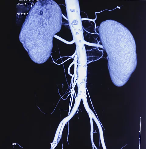 CT angiogram (CTA) shown the abdominal aorta, kidney and common iliac artery. Calcified plaques in lower part of aorta. Atherosclerotic change. CT angiography for determine vascular disease trauma.