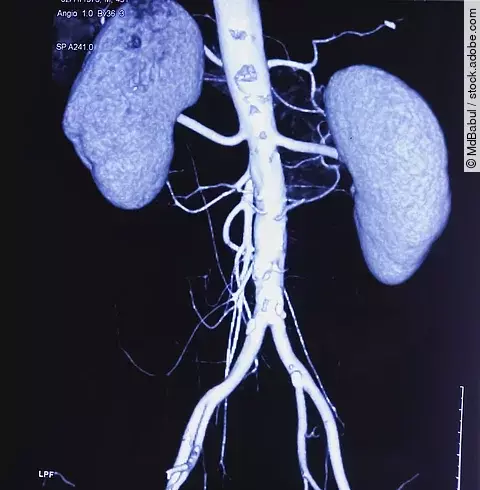 CT angiogram (CTA) shown the abdominal aorta, kidney and common iliac artery. Calcified plaques in lower part of aorta. Atherosclerotic change. CT angiography for determine vascular disease trauma.