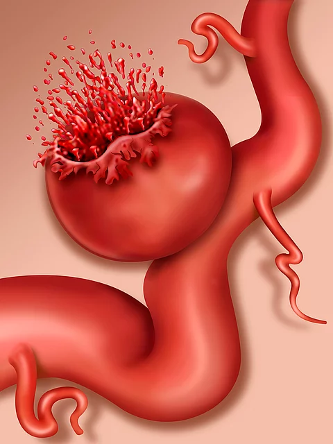 Ruptura aneurisma sacular Aneruysmenruptur