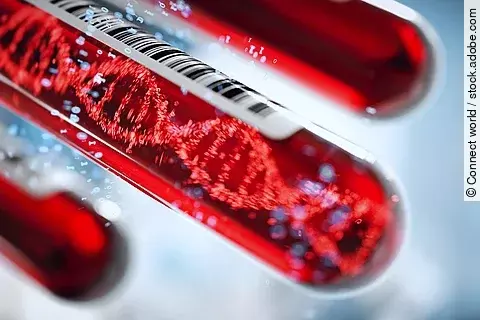 Bluttest für Pankreaskarzinom-Screening rückt in Reichweite