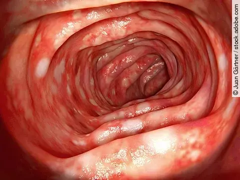 Colitis ulcerosa