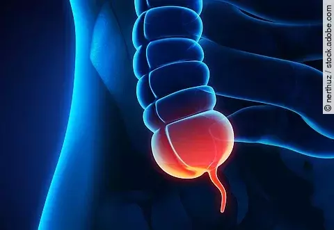 Entzündeter Wumfortsatz