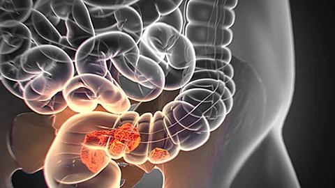 Medizinische Illustration des Darms mit einem Tumor im Dickdarm