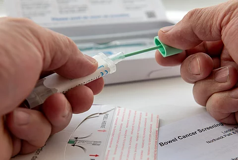 London. UK- 04.17.2024. A person putting the bowel cancer test sample in the sample holder before sending it off by mail for testing.