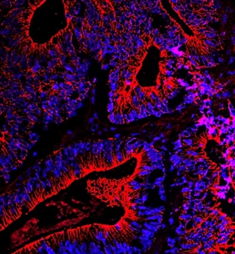 Dickdarmkrebs unter dem Fluoreszenzmikroskop