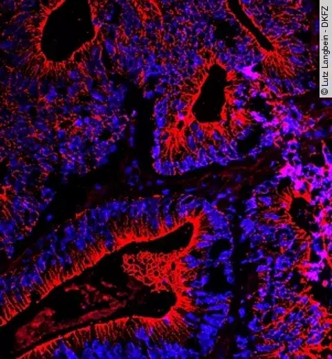 Dickdarmkrebs unter dem Fluoreszenzmikroskop