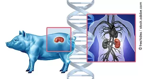 Pig Kidney Transplant concept as a genetically modified animal organ transferred to humans as Xenotransplantation technology or Xenogeneic transplantation as bioengineered DNA.
