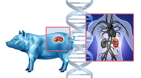 Pig Kidney Transplant concept as a genetically modified animal organ transferred to humans as Xenotransplantation technology or Xenogeneic transplantation as bioengineered DNA.