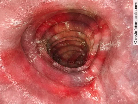 Colitis ulcerosa - Stadium 3