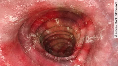 Colitis ulcerosa - Stadium 3