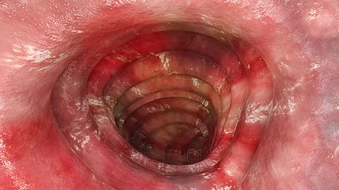 Colitis ulcerosa - Stadium 3