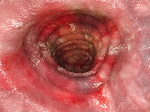 Colitis ulcerosa - Stadium 3