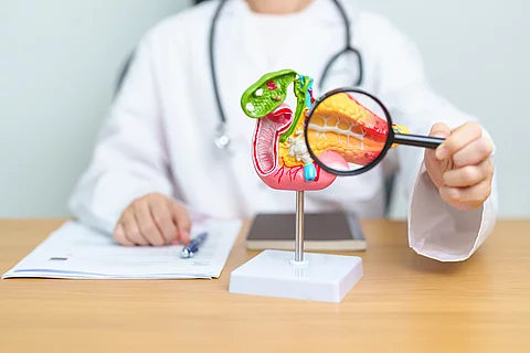 Pankreaskarzinom: Antibiotika verdoppeln Überlebenszeit bei Bauchspeicheldrüsenkrebs