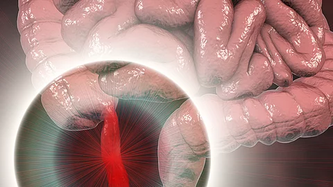 Appendizitis bei Kindern: OP statt Antibiotika
