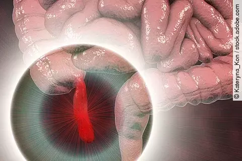 Appendizitis bei Kindern: OP statt Antibiotika