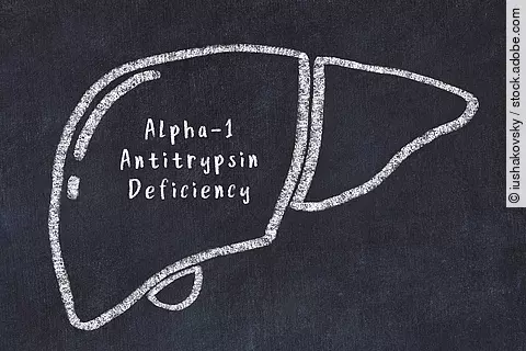 Welche Patienten mit Alpha-1-Antitrypsin-Mangel entwickeln eine Leberfibrose und welche nicht?