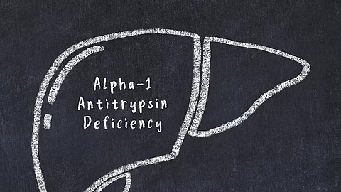 Welche Patienten mit Alpha-1-Antitrypsin-Mangel entwickeln eine Leberfibrose und welche nicht?