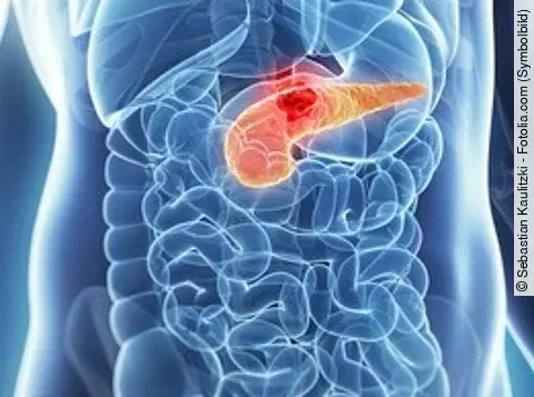 Tumor der Bauchspeicheldrüse