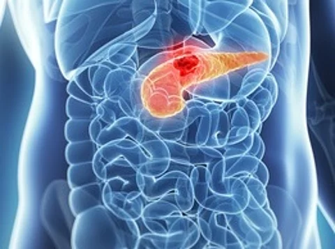 Tumor der Bauchspeicheldrüse