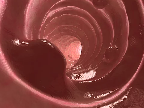 darmpolypen