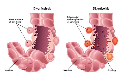 Diverticolite & Diverticolosi