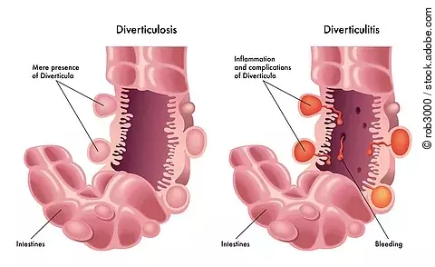 Diverticolite & Diverticolosi
