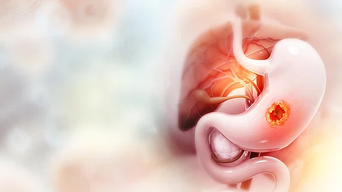 Illustration eines menschlichen Magens mit einer deutlich sichtbaren tumorartigen Läsion an der Magenwand.