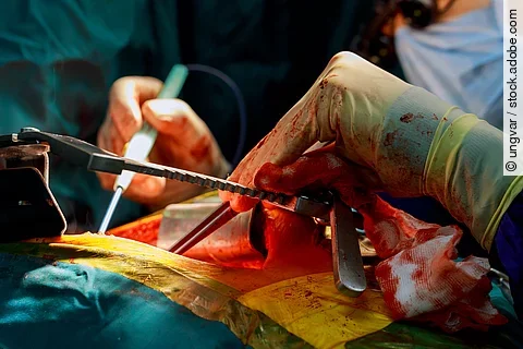 Lebertransplantation - Eingriff im OP-Saal