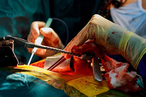 Lebertransplantation - Eingriff im OP-Saal