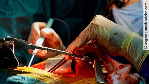 Lebertransplantation - Eingriff im OP-Saal Lebertransplantation - Eingriff im OP-Saal