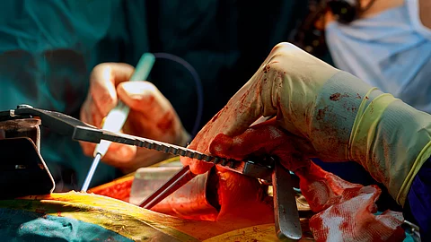 Lebertransplantation - Eingriff im OP-Saal