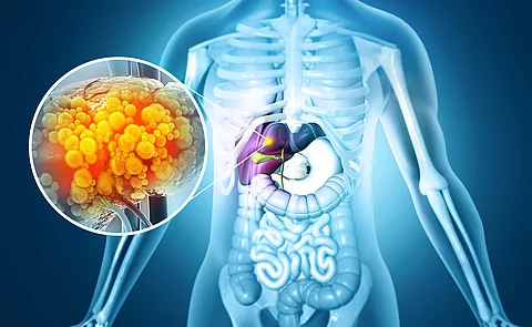 Liver damage such as Fatty liver, Fibrosis, Cirrhosis, and Liver cancer. 3d illustration