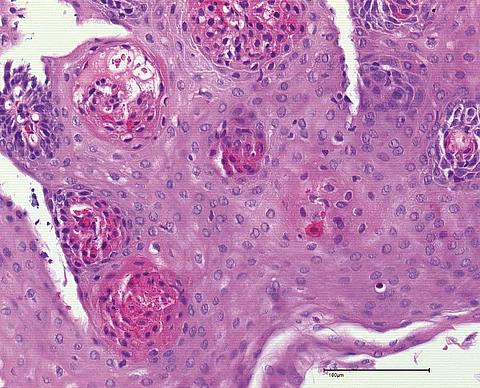 Histologisches Bild der eosinophilen Ösophagitis