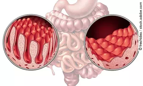 Celiac Coeliac Intestine Disease