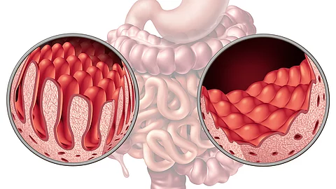 Celiac Coeliac Intestine Disease Celiac Coeliac Intestine Disease