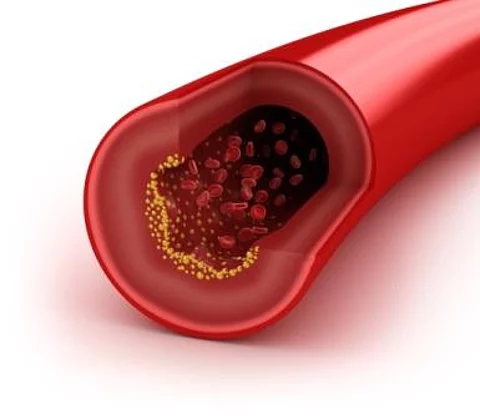 Blutgefäß mit Arteriosklerose
