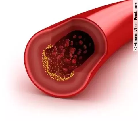 Blutgefäß mit Arteriosklerose