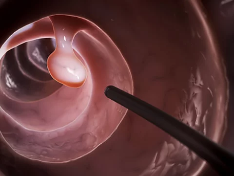 Polyp im Darm