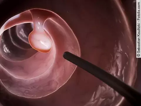 Polyp im Darm